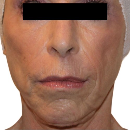Venus Legacy Facial Skin Tightening And Body Contouring - Victoria BC –  Glow Luxe SkinCare & Medispa
